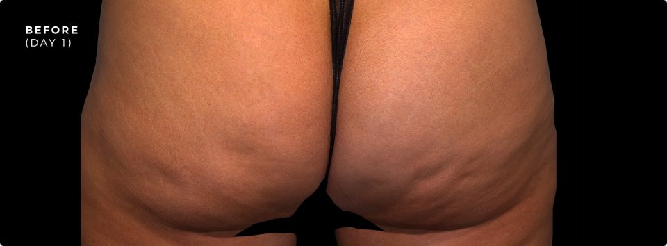 What Is Cellulite? - Baltimore, MD